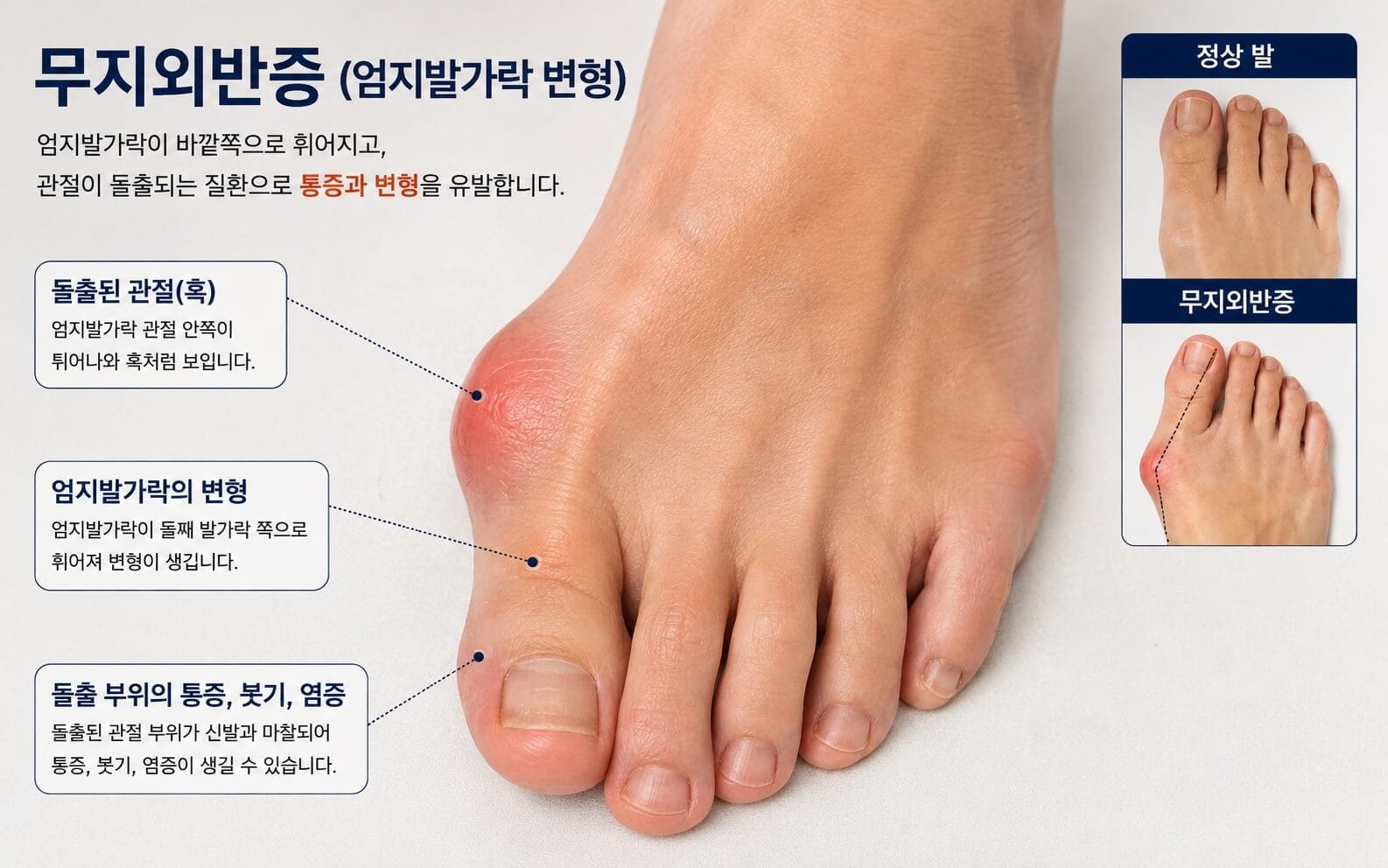 무지외반증 사진